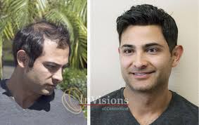 What to do about premature hair loss if you think you might be experiencing hair loss in your 20's and 30's, visit your doctor. Millenial Men Dealing With Hair Loss Thinning Hair Hair Loss Restoration Replacement Connecticut