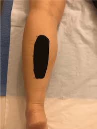 Take it and see how well you do! The Impact Of Kinesiology Tape Application On The Volume Of Interstitial Space Over The Gastrocnemius Within Healthy Mixed Gender Participants Using Ultrasonography