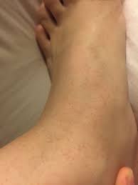 Skin Concern These Tiny Red Dots On The Top Of My Feet And Up My Legs Anyone Recognise It Have An Idea What It Could Be Skin Concern Skin Red Dots