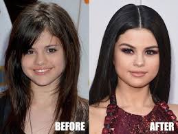 Selena Gomez Plastische Chirurgie Enthullt Vor Und Nach 2019 Chirurgie Enthullt Gomez Plastische Selena Hair Implants Celebrity Plastic Surgery Nose Job