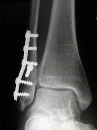 Spiral fracture of the upper third of the fibula with disruption of the distal tibiofibular syndesmosis and associated injuries (e.g., fracture of the medial malleolus, fracture of the posterior 1. Ankle Fractures Trauma Orthobullets