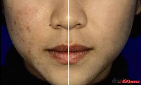 Action akan memakan waktu beberapa detik untuk menjalankannya. Cara Menghilangkan Jerawat Dengan Photoshop Dianisa Com