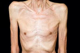 Unintended Weight Loss Red Flag Symptoms Gponline