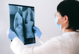 Lung cancer that has spread to the bones may cause pain at the sites of the affected bone. 10 Signs You May Have Lung Cancer Rediff Com Get Ahead