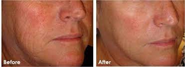 Lara devgan, md, mph, facs. Microinfusion Beverly Hills Los Angeles La Skinaesthetics