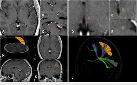 Image result for Thalamotomy