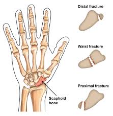 Image result for Scaphoid Fracture Signs