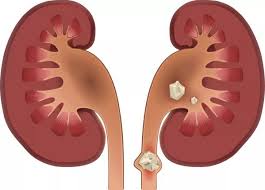 Image result for Nephrolithiasis