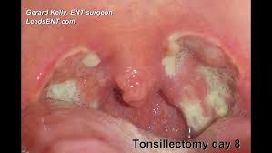 Image result for Tonsillectomy