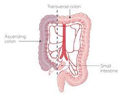 Welcome to the bowel cancer uk forum, a place for anyone affected by bowel cancer to ask questions, share. Colon Cancer Symptoms Causes Treatment Meril Life