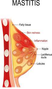 Mastitis Puerperalis Brustentzundung In Der Stillzeit Ursachen Symptome Behandlung Medlexi De