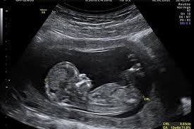 After about week 10 of gestation, one of those other things becomes pee. 44 Year Old Stone Baby Found In Elderly Brazilian Woman S Stomach X Rays Reveal Face Ribs And Spine Of Fetus