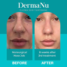 DermaNu Plasma Skin Tightening