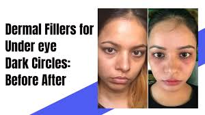 How much do dermal fillers cost? Filler Treatment In Delhi Cost Process Types 2021