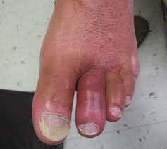 Image result for gout symptoms toe