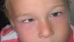 How does the doctor know my child has cancer? One Third Of Parents Say A Squint Is Not A Symptom Of Childhood Eye Cancer Childhood Eye Cancer Trust
