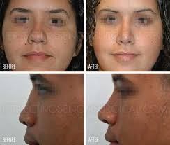 Make Nose Smaller Perfect Nose Non Surgical Nose Job In 2020 Make Nose Smaller Nose Job Perfect Nose