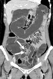 Learn about the symptoms, causes, and how to manage it. Bowel Endometriosis Ct Enteroclysis Springerlink