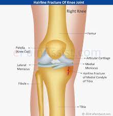 Hairline Fracture Of Knee Joint Knee Injury Knee Joint Hairline Fracture