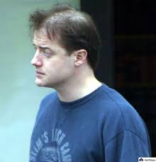 Brendan Fraser Hair Transplant: A Star's Revival