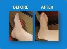 1 Natural Supplement For Swollen Feet Ankles Legs Swollen Feet Swollen Legs Swelling Feet
