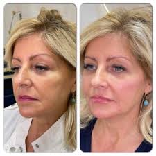 Temple Filler Scottsdale