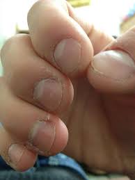 Did You Know That One In Four People Bites His Or Her Nails Regularly Nails That Have Been Bitten To The Nail Biting Remedies Nail Biting Habit Nails For Kids