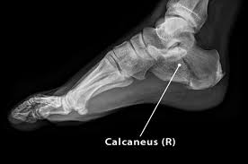 Image result for Calcaneus