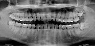 Wann müssen weisheitszähne gezogen werden? Zahnarzt Marburg Chirurgische Entfernung Von Zahnen Verlagerte Retinierte Weisheitszahne Eckzahne Dentitio Difficilis Osteotomie Ost