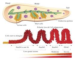 The first is the blockage of the bile duct by tumor and the second is the invasion and destruction of the liver. Targeted Therapies For Pancreatic Cancer And Hurdles Ahead Anticancer Research
