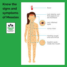 Image result for measles