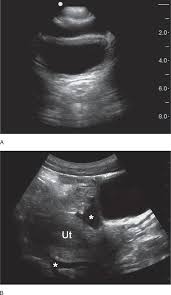 Diagnosing The Cause Of And Measuring Cul-De-Sac Fluid | Empowered Women'S  Health