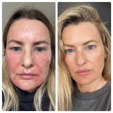 Let's show some love for beautiful Suzy. What a fantastic result 💛  @suzymeekmua : I have had amazing results with Zoe Bee cream. I used  charcoal and oat for a while to