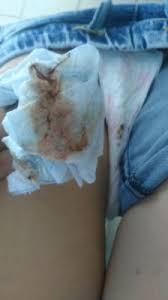Flujo Vaginal Cafe Y Despues Leve Sangrado Anormal Cafe Ayuda Urgente Primeros Sintomas Babycenter