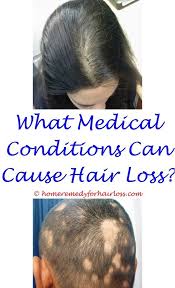 Hair Loss Bhringraj Shampoo Hair Loss Hair Transplant Graft Loss Bleeding Hair Loss How Much Hair Loss I Problem Hair Loss Hair Loss Hypothyroidism Hair Loss