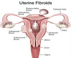If fibroids are large in size, a women can experience abdominal distension, shortness of breath, feeling full quickly after eating a small meal, going to the bathroom more frequently to urinate and experiencing pelvic pressure, explains dr. Fibroids Philippe De Rosnay