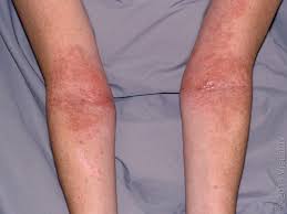 Image result for skin rash similar to scabies