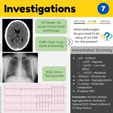 Image result for Intubation Associated Sinusitis
