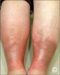 Image result for Lipodermatosclerosis