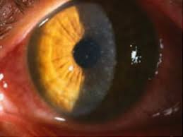 Image result for Viral Conjunctivitis
