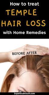 Hair Loss On Temples Causes And Home Remedies Temple Hair Loss Treat Hair Loss Hair Loss Women