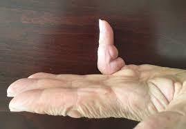 When sitting on an office chair at a desk, arms should be flexed at a 75 to 90 degree angle at the elbows. Dupuytren S Contracture Of 90 Degree Angle Download Scientific Diagram