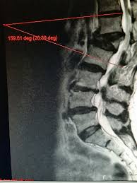Image result for Vertebral Compression Fracture