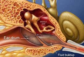 What Is Meniere S Disease Symptoms Diet Treatment