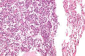 Carcinoid tumors of the midgut (jejunum, ileum, appendix, and cecum). Tumor Carcinoide De Pulmao Wikipedia A Enciclopedia Livre