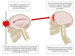 When the head is struck by a hard object the cerebral cortex (gray when the blunt object comes into contact with the bones of the human skull several reactions are possible. Forensic Traumatology Blunt And Penetrating Trauma