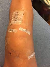 Post Surgery Acl Tear Acl Tear Post Surgery Tattoos