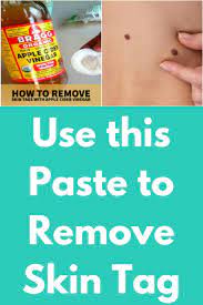 Use This Paste To Remove Skin Tag In 1 Night Skin Tag Removal Skin Tag Diy Skin Cream