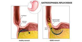 Gastroesophageal reflux disease (gerd), or just acid reflux, is when stomach acid frequently flows back into the esophagus. Gerd Acid Reflux Heartburn Symptoms Treatment Gleneagles Hospital