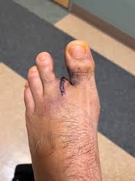 Image result for toe amputation